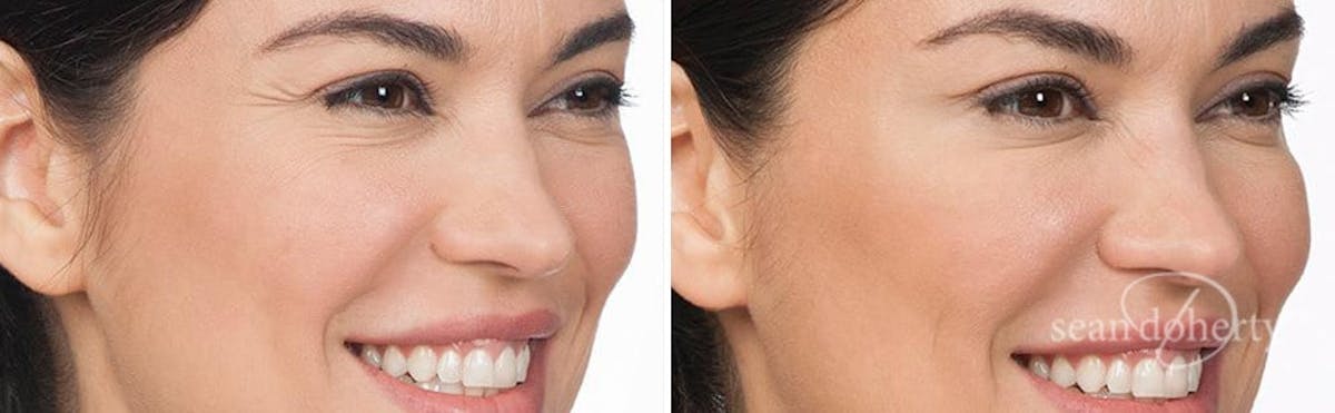 Botox Before & After Gallery - Patient 676530 - Image 2