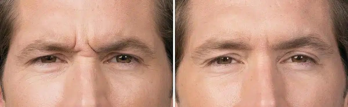 Botox Before & After Gallery - Patient 285383 - Image 1