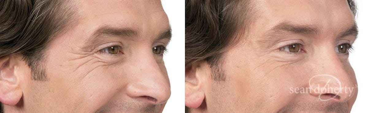 Botox Before & After Gallery - Patient 285383 - Image 2