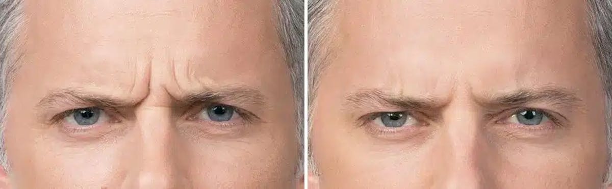 Botox Before & After Gallery - Patient 278665 - Image 1