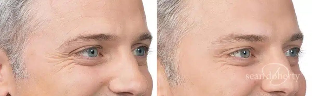 Botox Before & After Gallery - Patient 278665 - Image 2