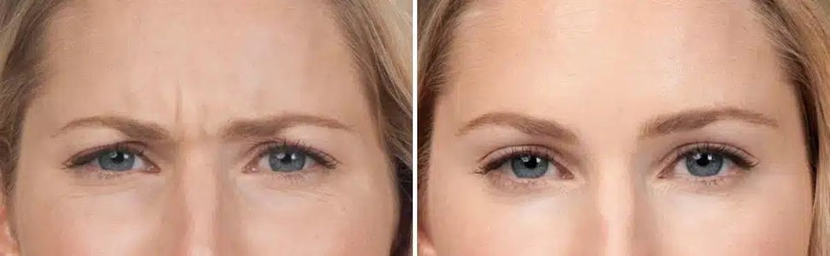 Botox Before & After Gallery - Patient 229295 - Image 1