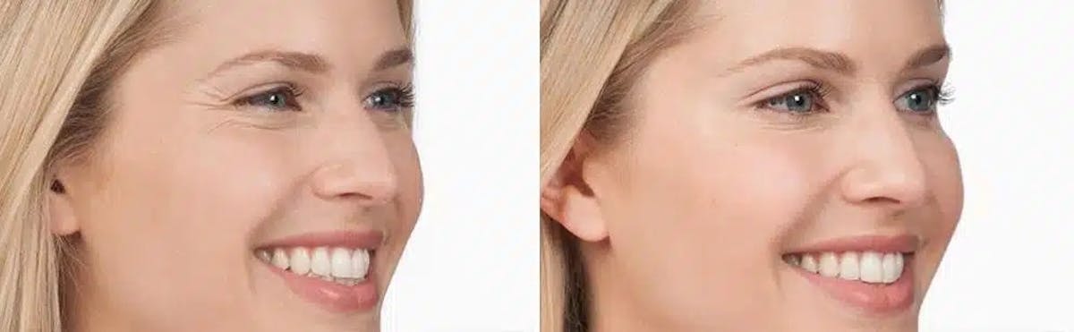 Botox Before & After Gallery - Patient 229295 - Image 2