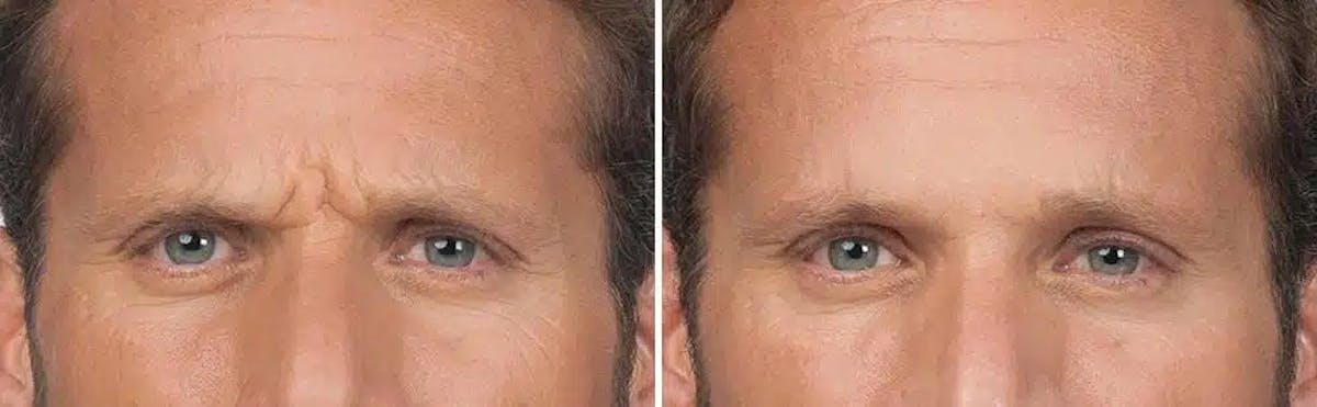 Botox Before & After Gallery - Patient 383599 - Image 1