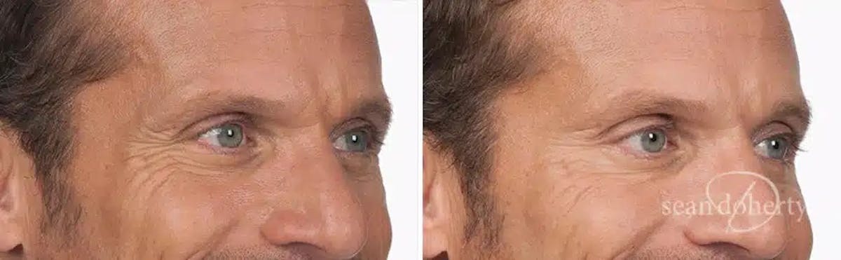 Botox Before & After Gallery - Patient 383599 - Image 2