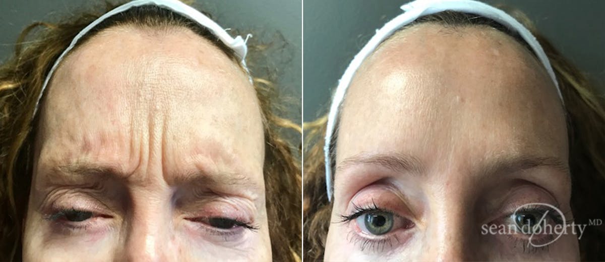 Botox Before & After Gallery - Patient 245319 - Image 1