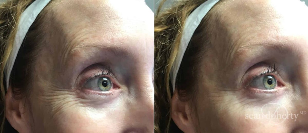 Botox Before & After Gallery - Patient 245319 - Image 2