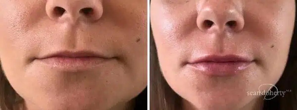 Lip Augmentation Before & After Gallery - Patient 549353 - Image 1