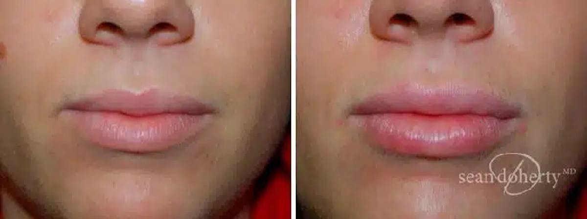 Lip Augmentation Before & After Gallery - Patient 342440 - Image 1