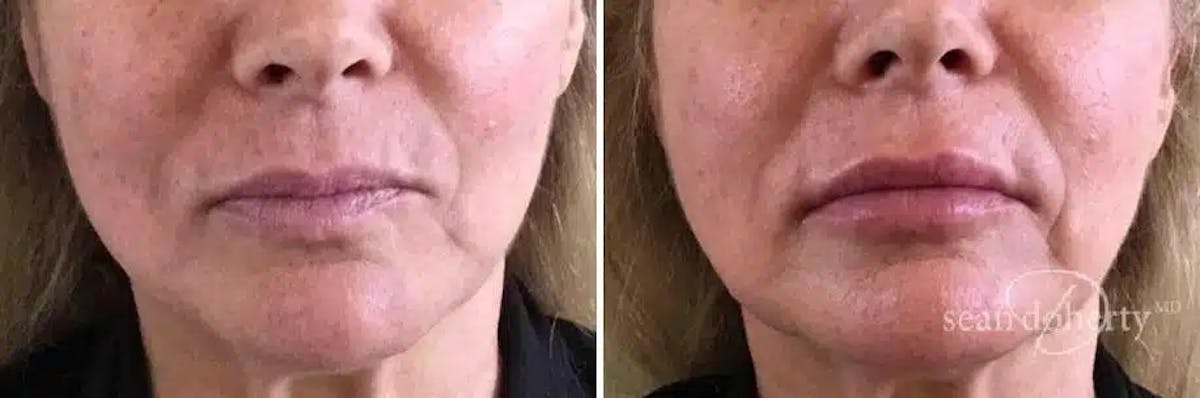 Lip Augmentation Before & After Gallery - Patient 354043 - Image 1