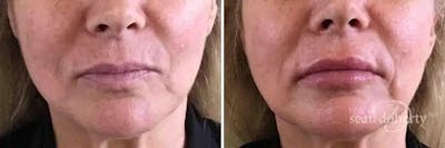 Lip Augmentation Before & After Gallery - Patient 354043 - Image 1