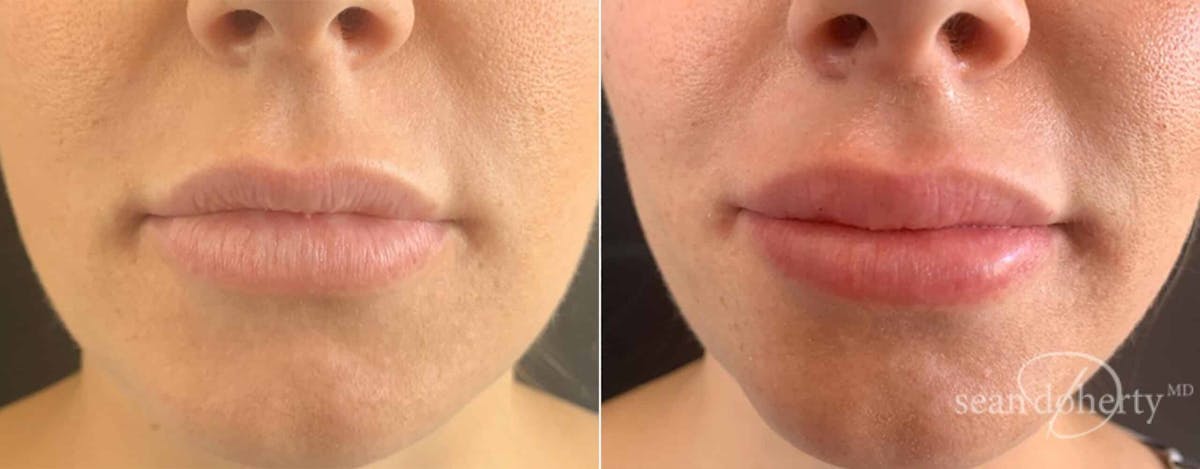 Lip Augmentation Before & After Gallery - Patient 966433 - Image 1
