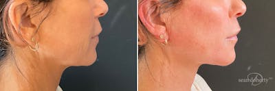 PDO Threads Before & After Gallery - Patient 902105 - Image 1