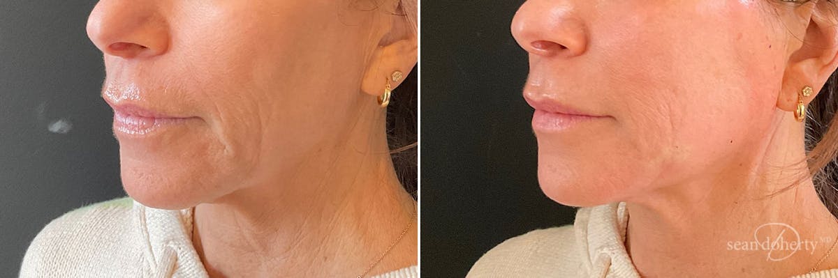 PDO Threads Before & After Gallery - Patient 902105 - Image 2