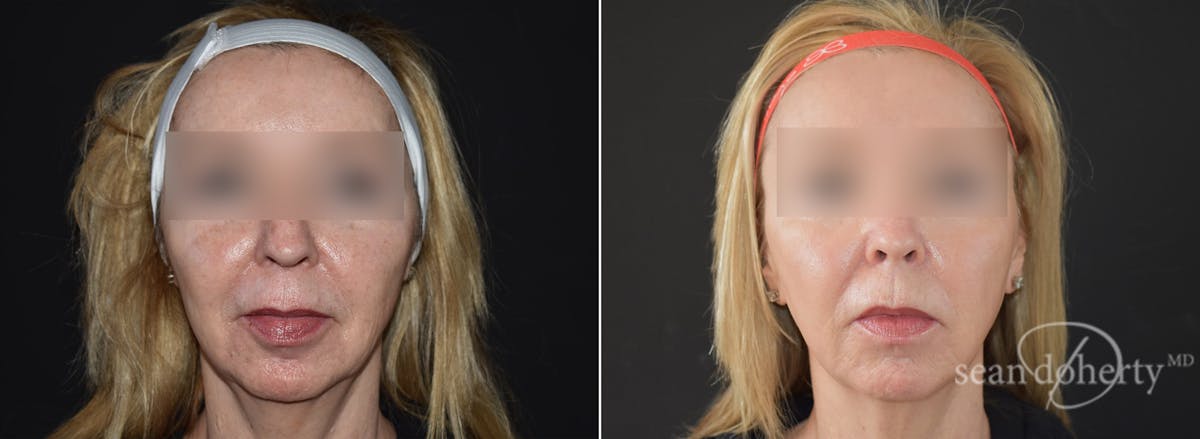CO2 Laser Resurfacing Before & After Gallery - Patient 388123 - Image 3