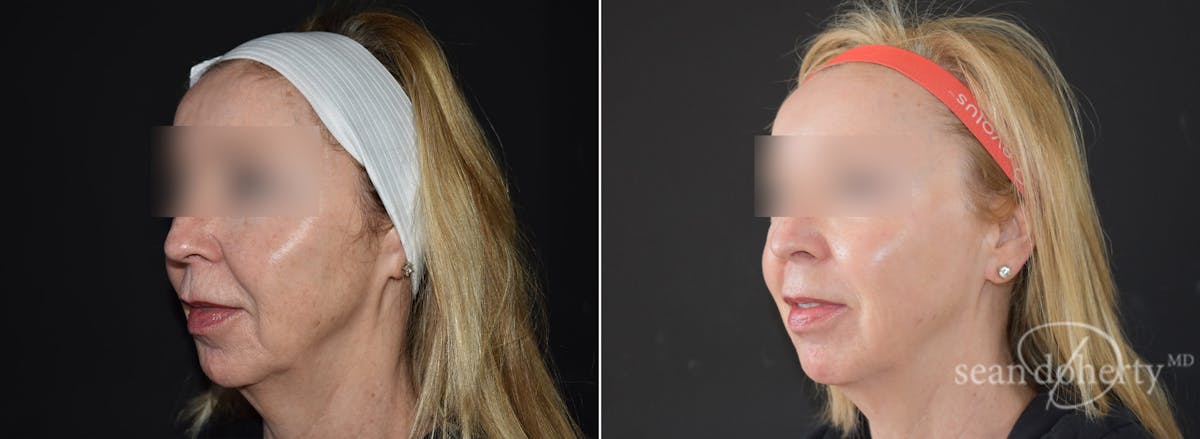 CO2 Laser Resurfacing Before & After Gallery - Patient 388123 - Image 1