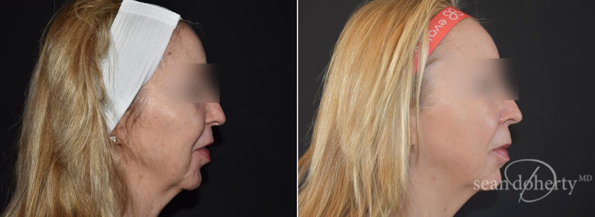 CO2 Laser Resurfacing Before & After Gallery - Patient 388123 - Image 2
