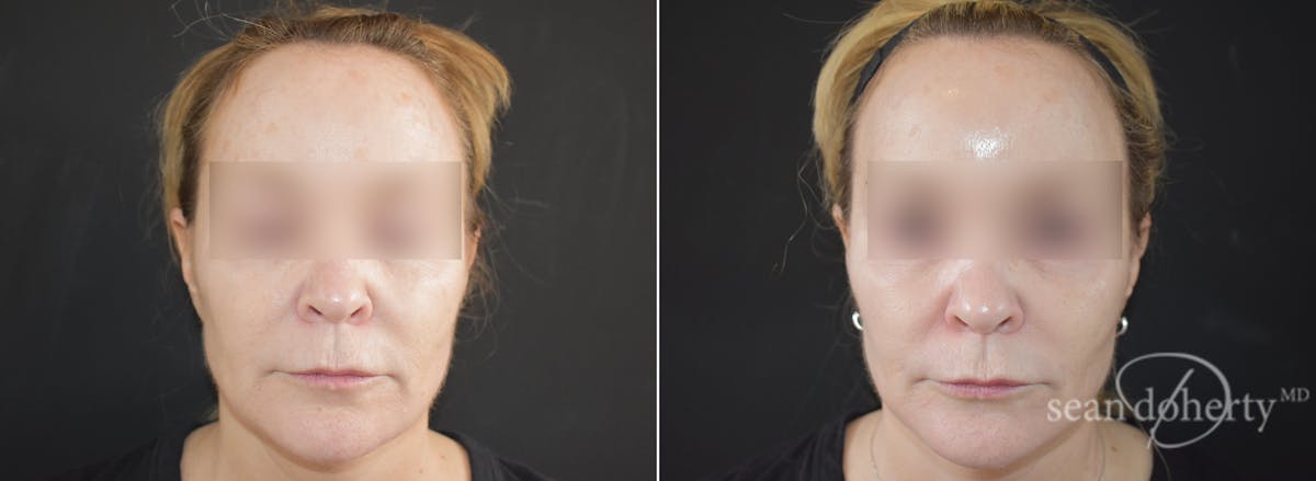 CO2 Laser Resurfacing Before & After Gallery - Patient 123899 - Image 3