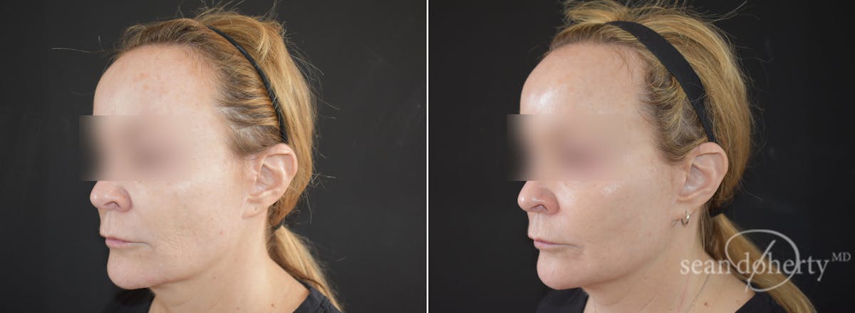 CO2 Laser Resurfacing Before & After Gallery - Patient 123899 - Image 2
