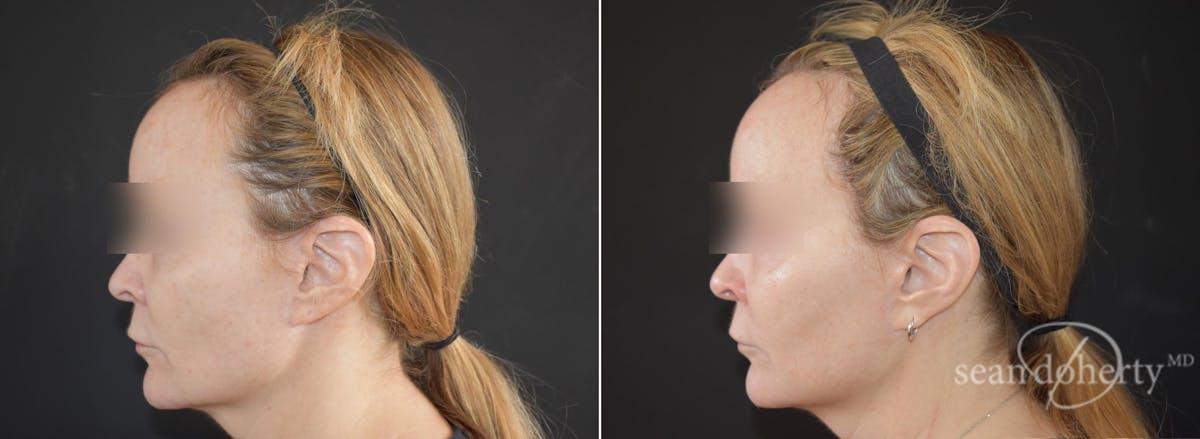 CO2 Laser Resurfacing Before & After Gallery - Patient 123899 - Image 1