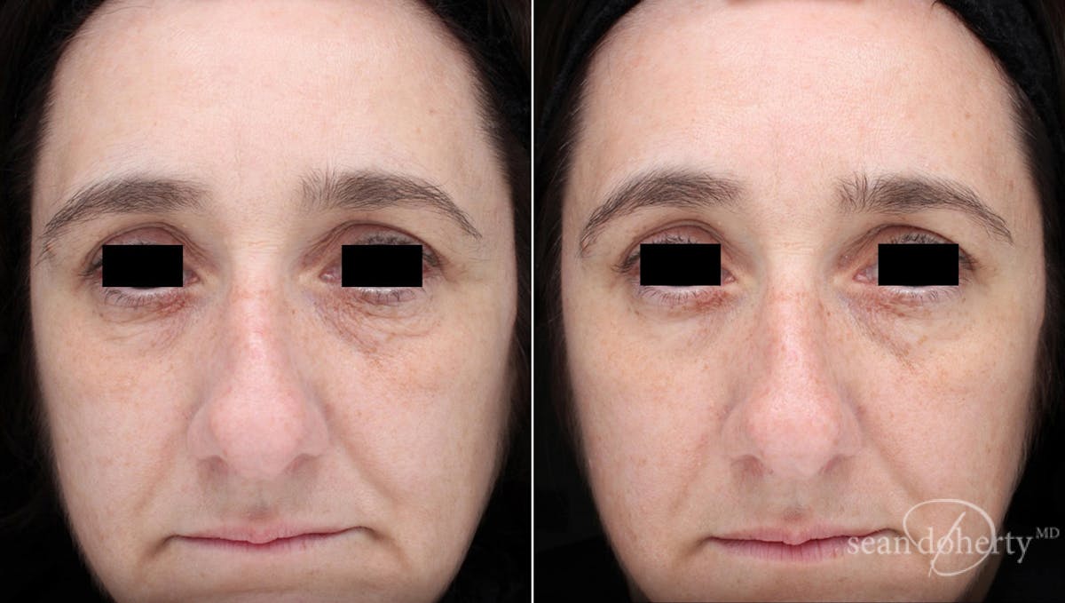 Skin Tightening Before & After Gallery - Patient 367114 - Image 1