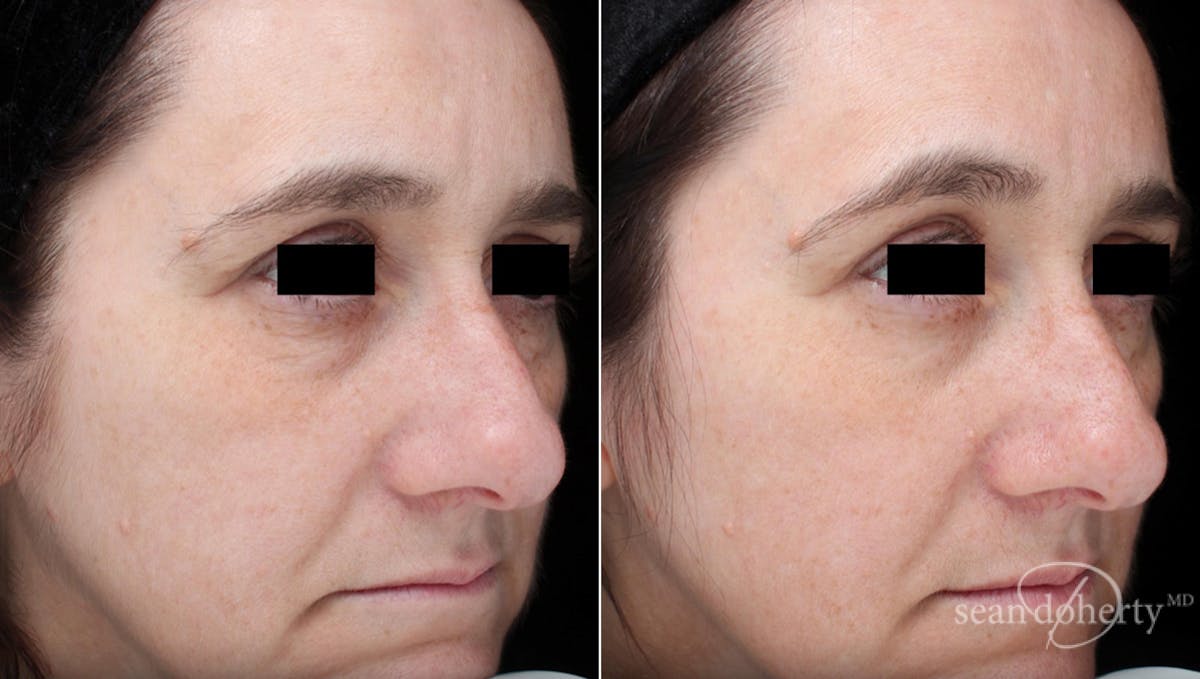 Skin Tightening Before & After Gallery - Patient 367114 - Image 2