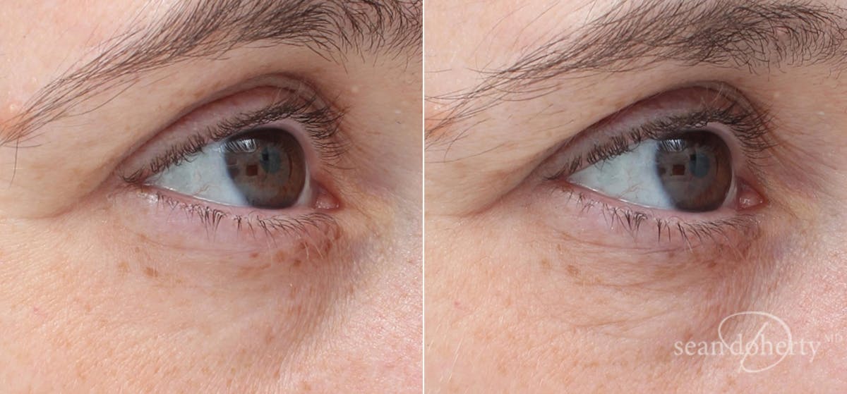 Skin Tightening Before & After Gallery - Patient 251726 - Image 1
