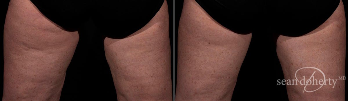 Skin Tightening Before & After Gallery - Patient 796028 - Image 1