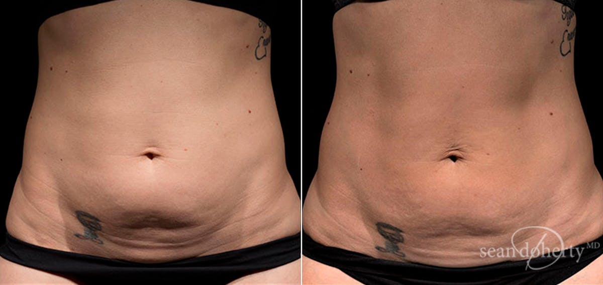 Skin Tightening Before & After Gallery - Patient 122005 - Image 1