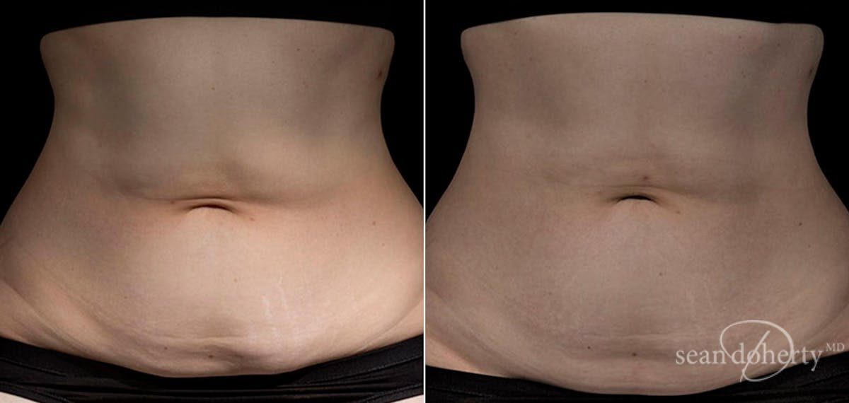 Skin Tightening Before & After Gallery - Patient 103607 - Image 1