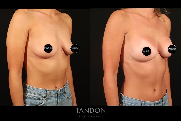 Preservé by Motiva Breast Augmentation Before & After Gallery - Patient 270312 - Image 2