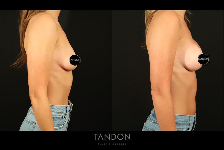 Preservé by Motiva Breast Augmentation Before & After Gallery - Patient 270312 - Image 3