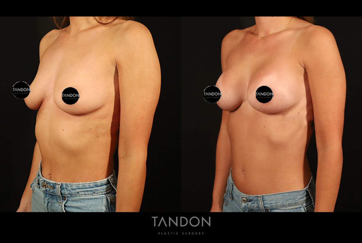 Preservé by Motiva Breast Augmentation Before & After Gallery - Patient 270312 - Image 5