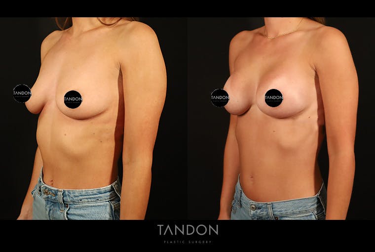 Preservé by Motiva Breast Augmentation Before & After Gallery - Patient 270312 - Image 5