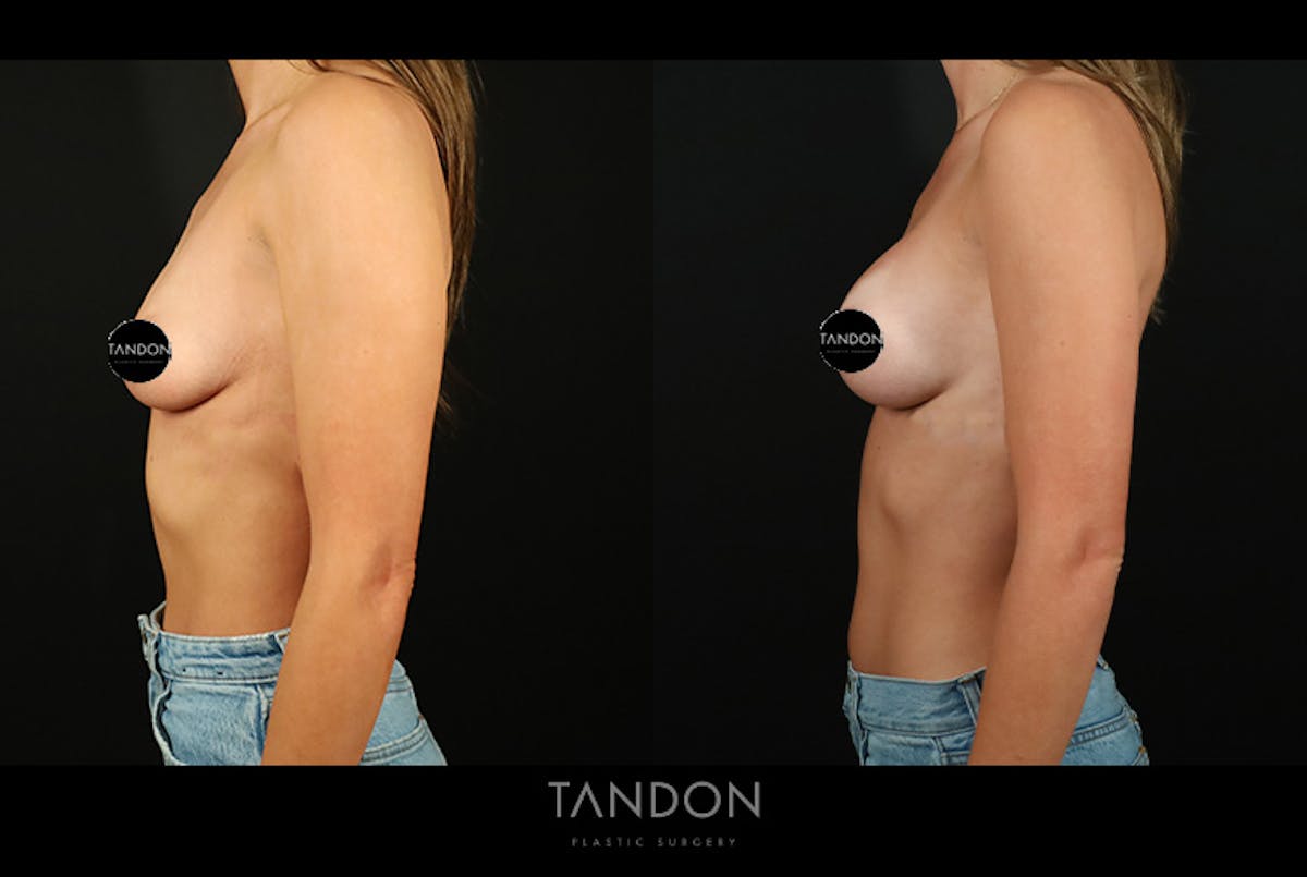 Preservé by Motiva Breast Augmentation Before & After Gallery - Patient 270312 - Image 4