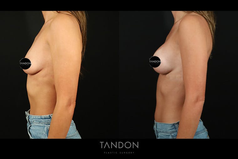 Preservé by Motiva Breast Augmentation Before & After Gallery - Patient 270312 - Image 4
