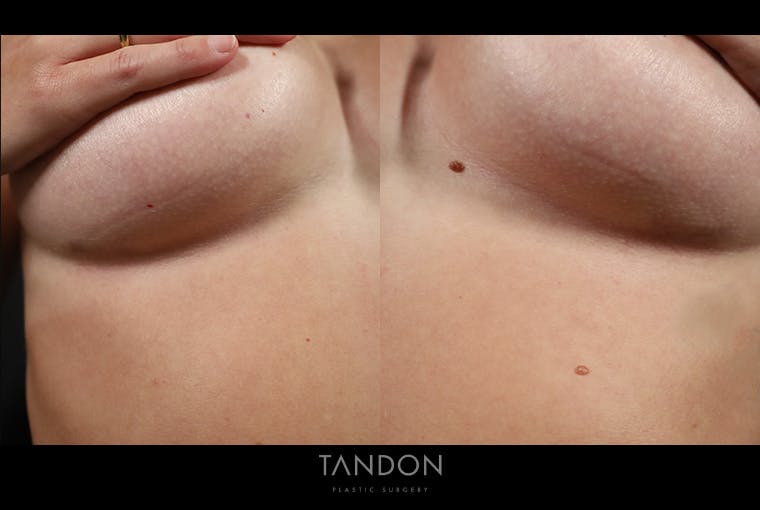 Preservé by Motiva Breast Augmentation Before & After Gallery - Patient 270312 - Image 6