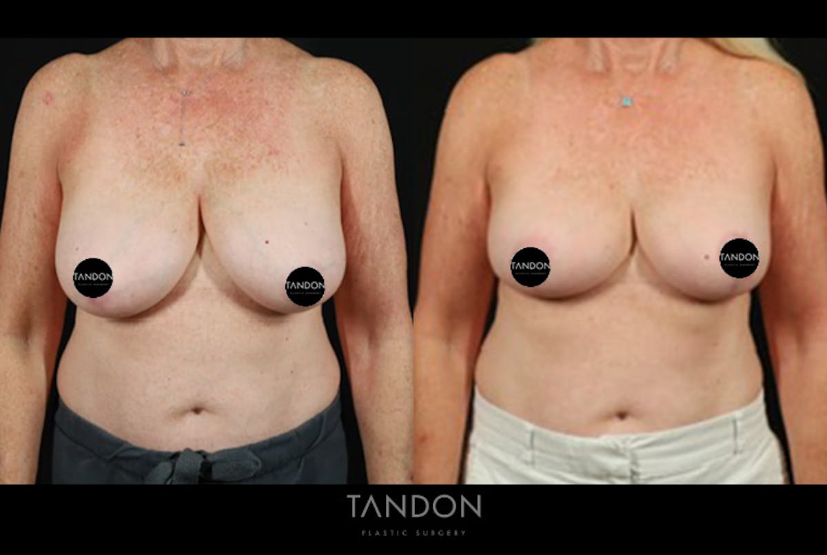 Breast Reduction Before & After Gallery - Patient 421689 - Image 1