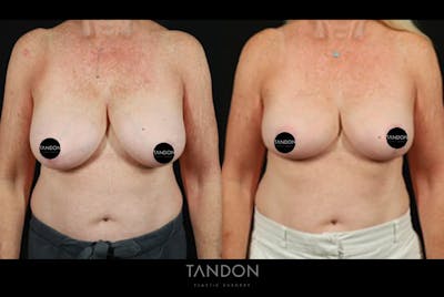 Breast Reduction Before & After Gallery - Patient 421689 - Image 1