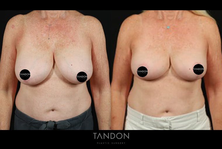 Breast Reduction Before & After Gallery - Patient 421689 - Image 1