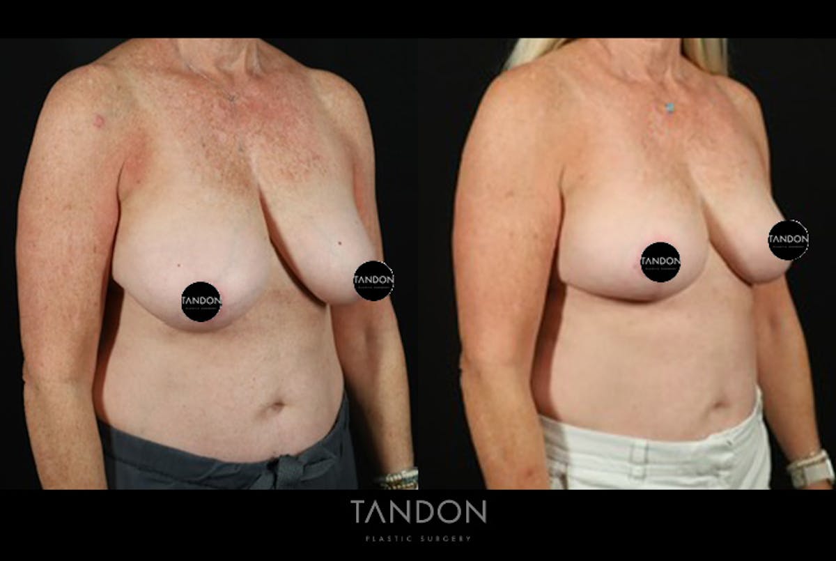Breast Reduction Before & After Gallery - Patient 421689 - Image 2