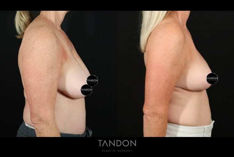 Breast Reduction Before & After Gallery - Patient 421689 - Image 3