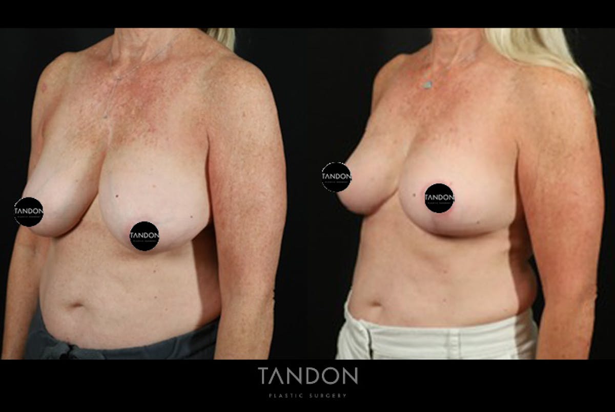 Breast Reduction Before & After Gallery - Patient 421689 - Image 4
