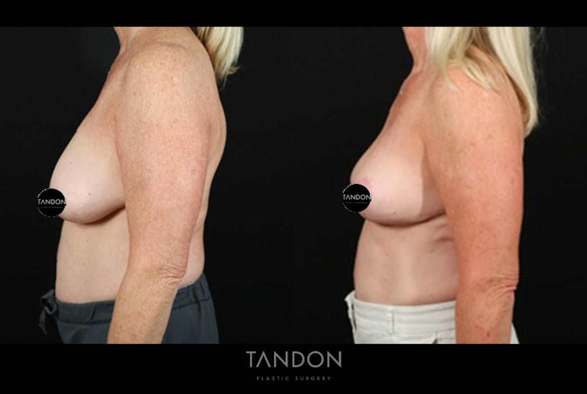 Breast Reduction Before & After Gallery - Patient 421689 - Image 5