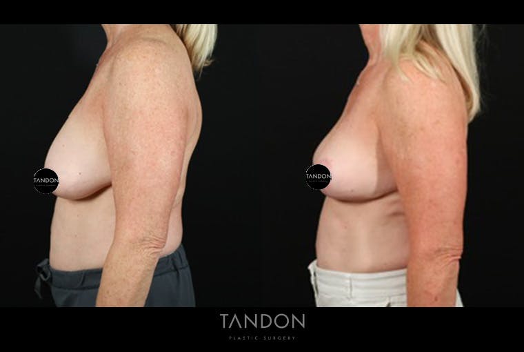 Breast Reduction Before & After Gallery - Patient 421689 - Image 5
