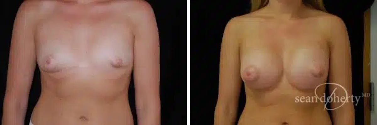 Breast Augmentation  Before & After Gallery - Patient 309403 - Image 1