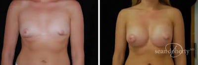 Breast Augmentation Before & After Gallery - Patient 309403 - Image 1