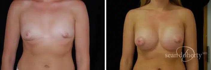 Breast Augmentation Before & After Gallery - Patient 309403 - Image 1
