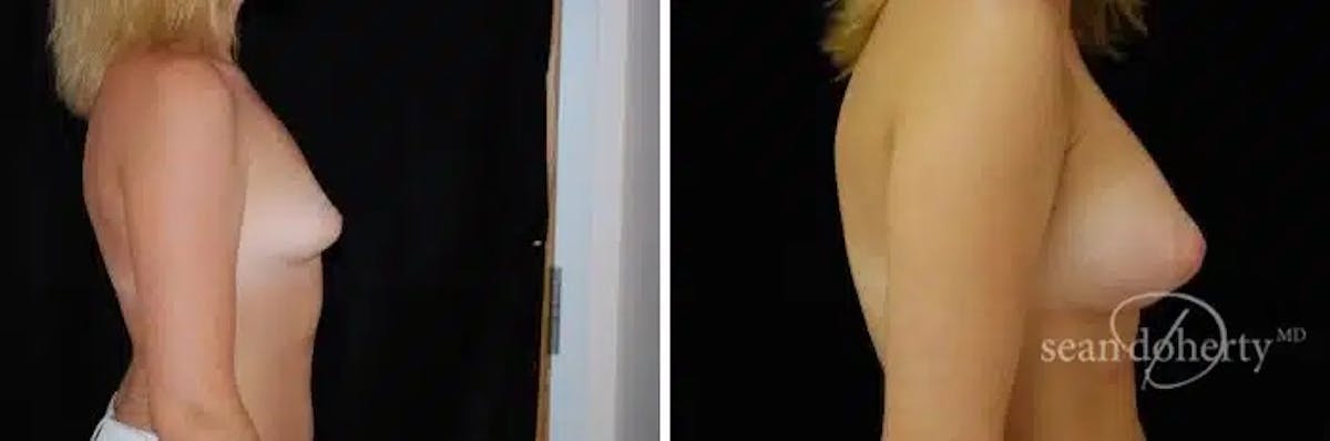Breast Augmentation  Before & After Gallery - Patient 309403 - Image 2