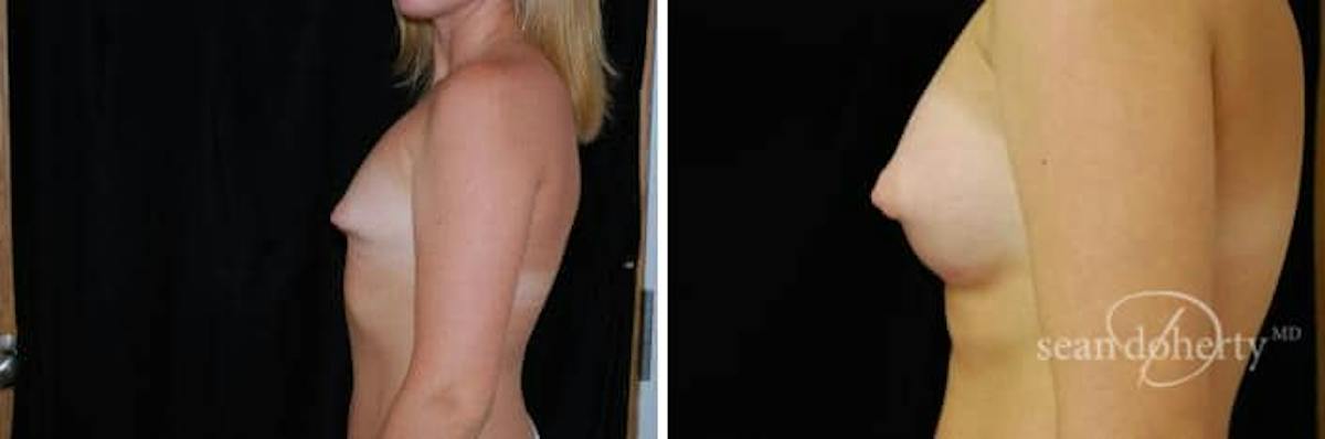 Breast Augmentation Before & After Gallery - Patient 309403 - Image 3